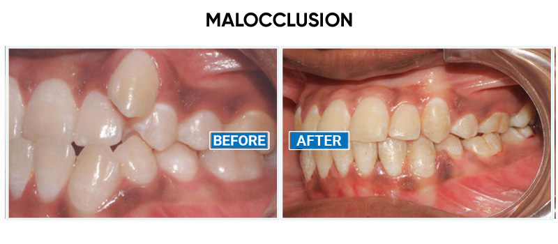 teeth braces